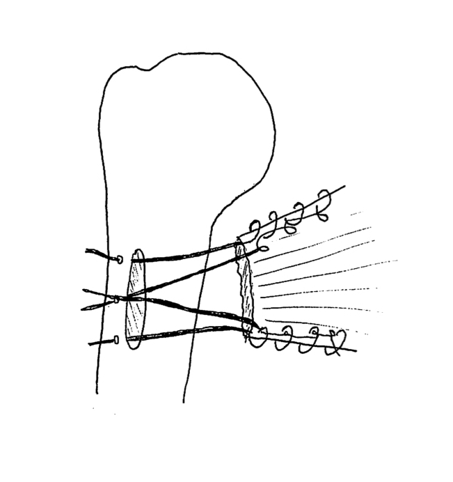 Pect Major Repair Through Bone Trough